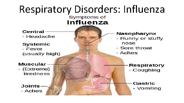 Respiratory Disorders: Influenza 