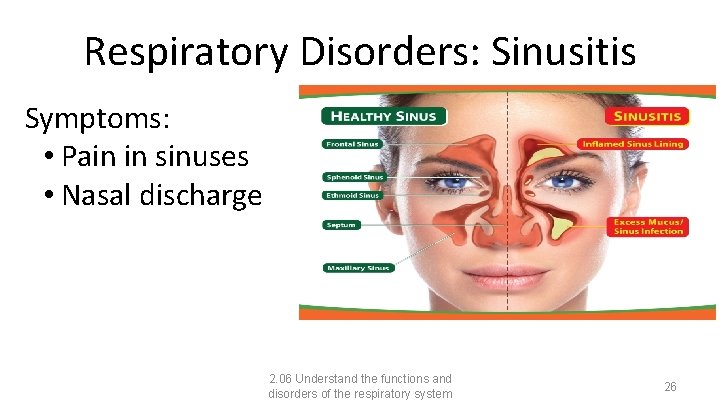 Respiratory Disorders: Sinusitis Symptoms: • Pain in sinuses • Nasal discharge 2. 06 Understand
