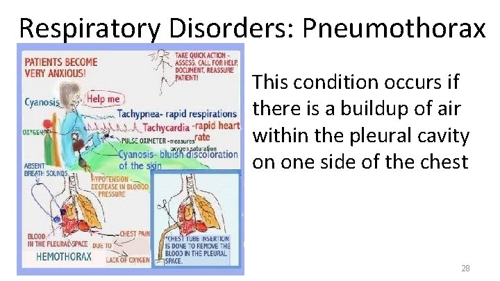 Respiratory Disorders: Pneumothorax This condition occurs if there is a buildup of air within