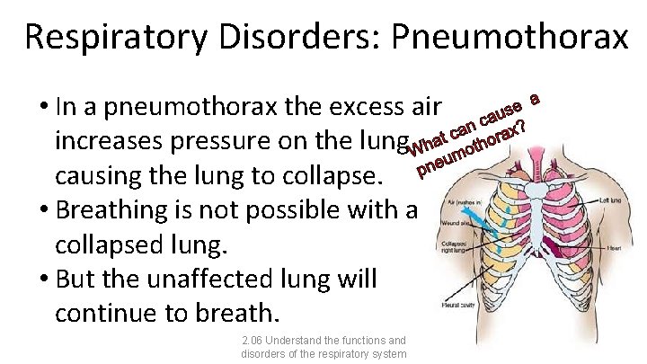 Respiratory Disorders: Pneumothorax • In a pneumothorax the excess air increases pressure on the