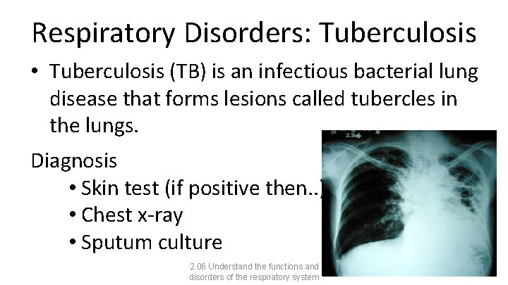 Respiratory Disorders: Tuberculosis • Tuberculosis (TB) is an infectious bacterial lung disease that forms