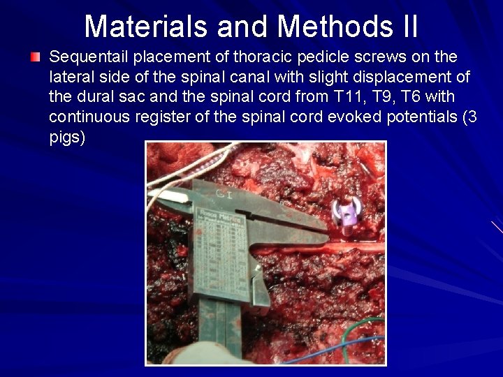 Materials and Methods II Sequentail placement of thoracic pedicle screws on the lateral side