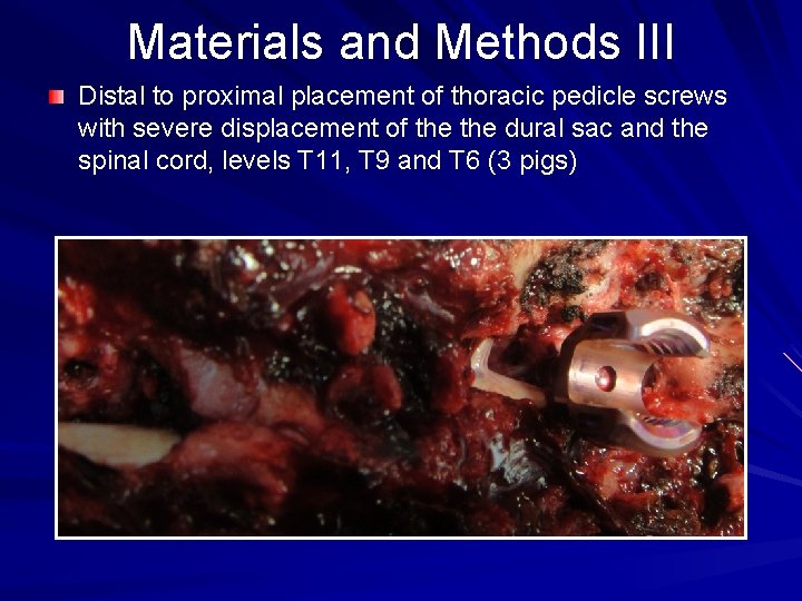 Materials and Methods III Distal to proximal placement of thoracic pedicle screws with severe