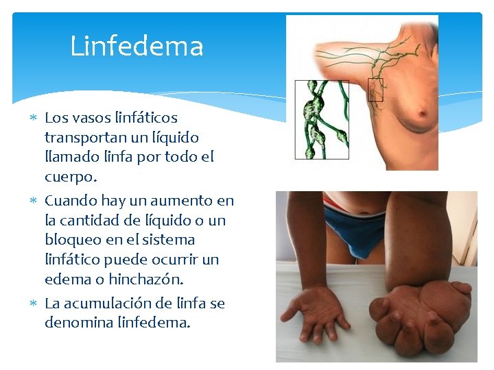 Linfedema Los vasos linfáticos transportan un líquido llamado linfa por todo el cuerpo. Cuando