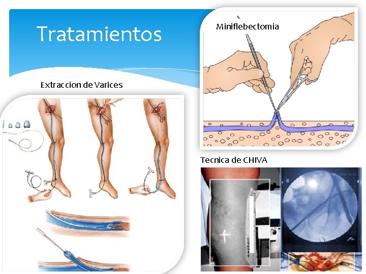 Tratamientos Miniflebectomia Extraccion de Varices Tecnica de CHIVA 