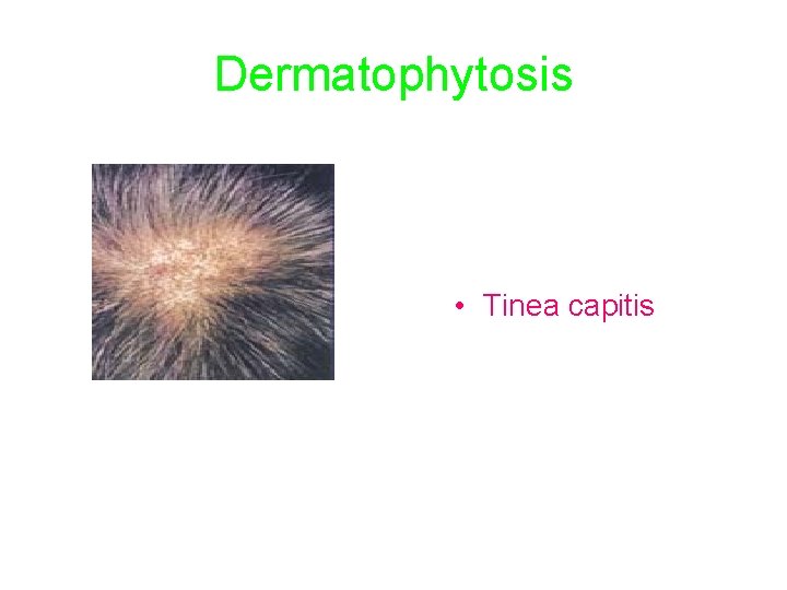 Dermatophytosis • Tinea capitis 