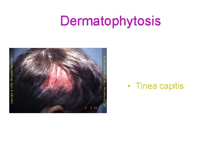 Dermatophytosis • Tinea capitis 