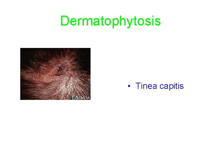 Dermatophytosis • Tinea capitis 