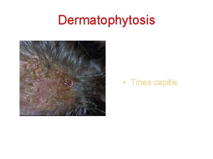 Dermatophytosis • Tinea capitis 