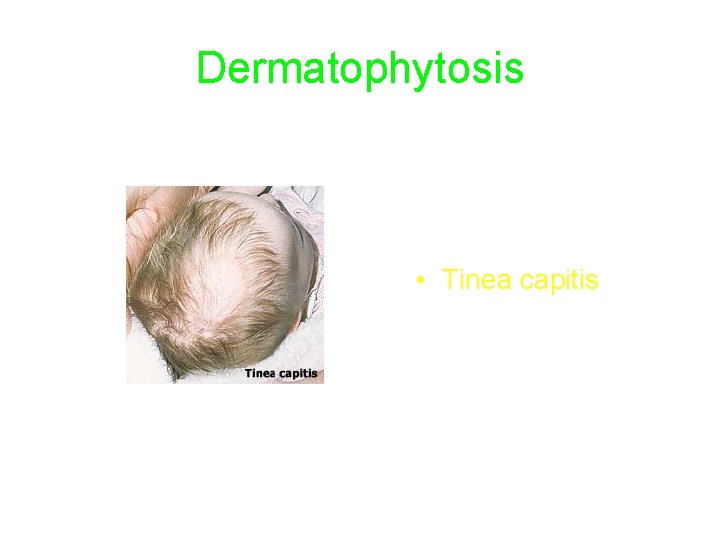 Dermatophytosis • Tinea capitis 