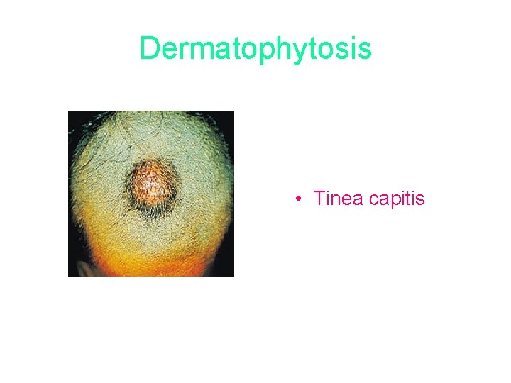 Dermatophytosis • Tinea capitis 