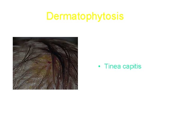 Dermatophytosis • Tinea capitis 