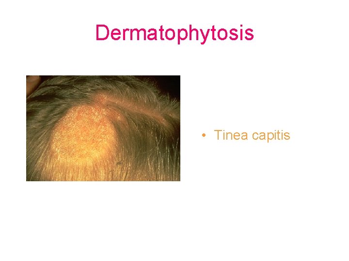 Dermatophytosis • Tinea capitis 