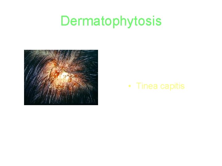 Dermatophytosis • Tinea capitis 