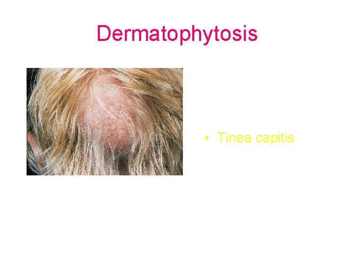 Dermatophytosis • Tinea capitis 