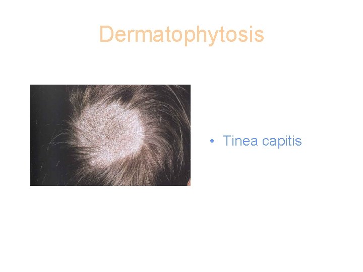 Dermatophytosis • Tinea capitis 