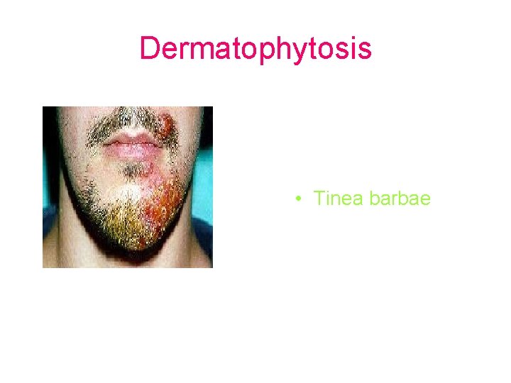 Dermatophytosis • Tinea barbae 