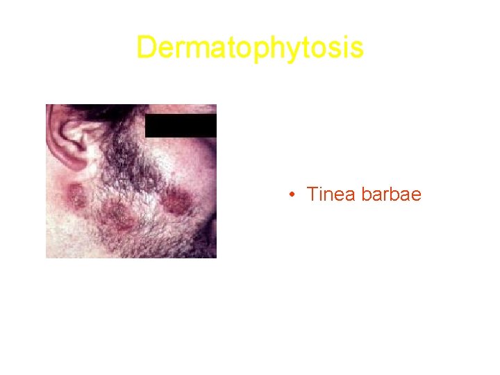 Dermatophytosis • Tinea barbae 