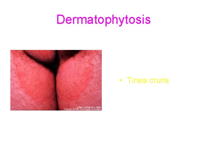 Dermatophytosis • Tinea cruris 