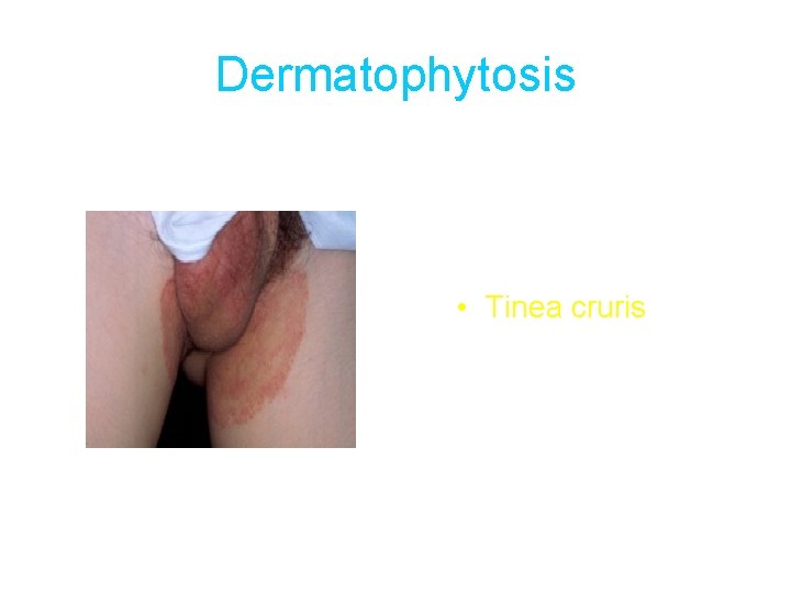Dermatophytosis • Tinea cruris 