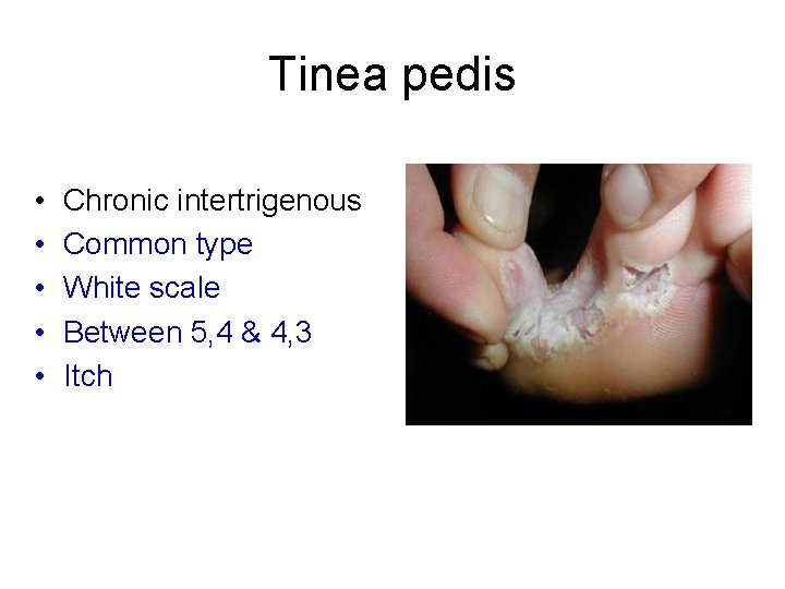 Tinea pedis • • • Chronic intertrigenous Common type White scale Between 5, 4