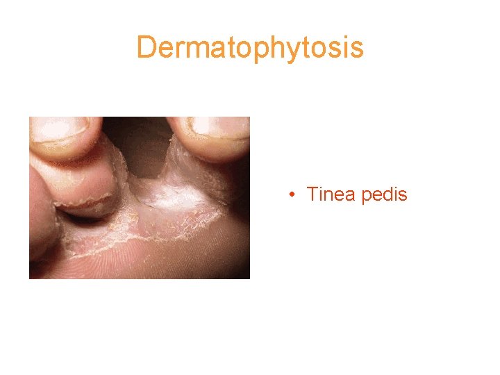 Dermatophytosis • Tinea pedis 