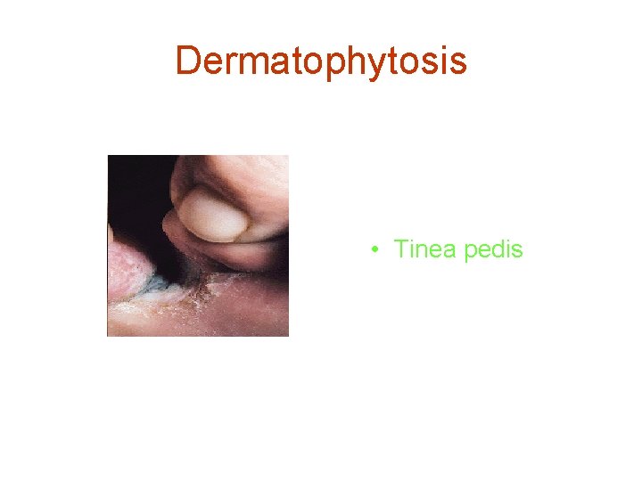 Dermatophytosis • Tinea pedis 