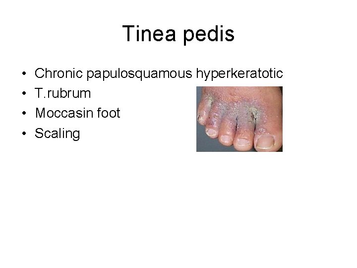 Tinea pedis • • Chronic papulosquamous hyperkeratotic T. rubrum Moccasin foot Scaling 