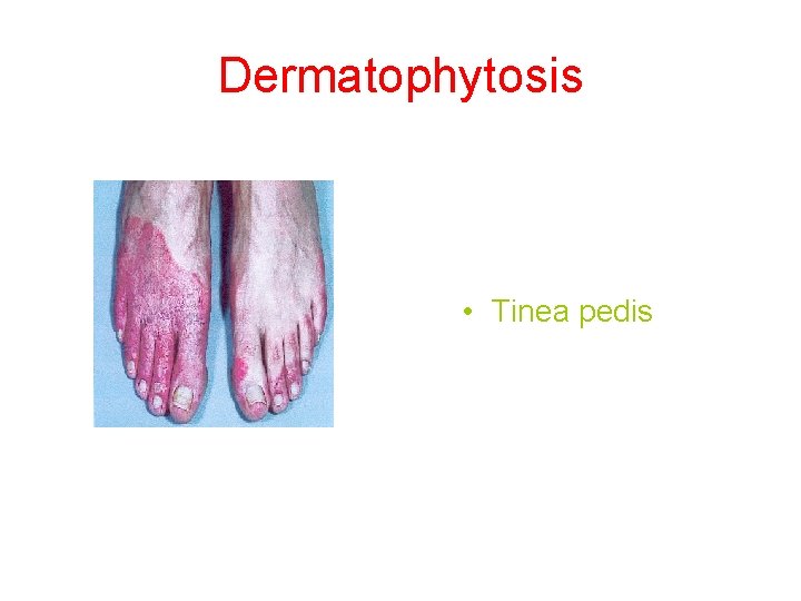 Dermatophytosis • Tinea pedis 