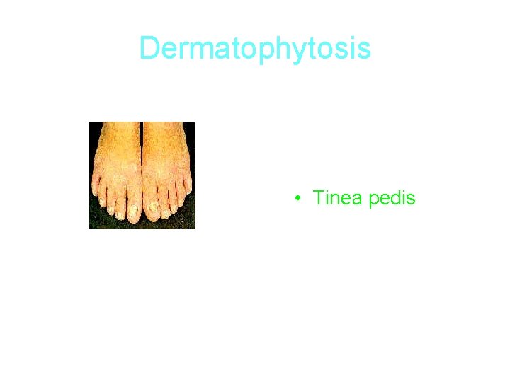 Dermatophytosis • Tinea pedis 