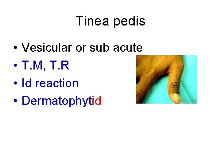 Tinea pedis • • Vesicular or sub acute T. M, T. R Id reaction