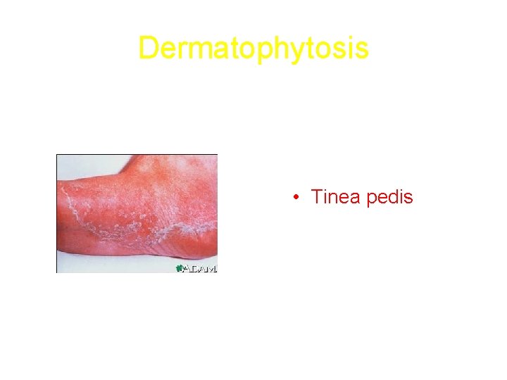 Dermatophytosis • Tinea pedis 