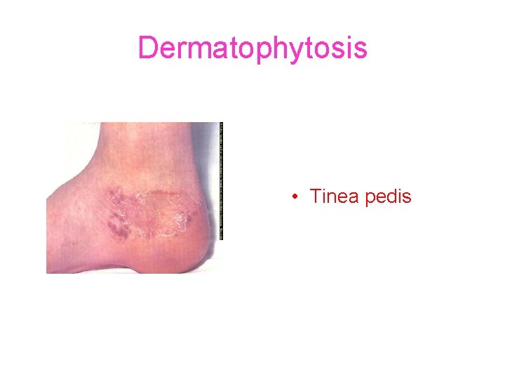 Dermatophytosis • Tinea pedis 