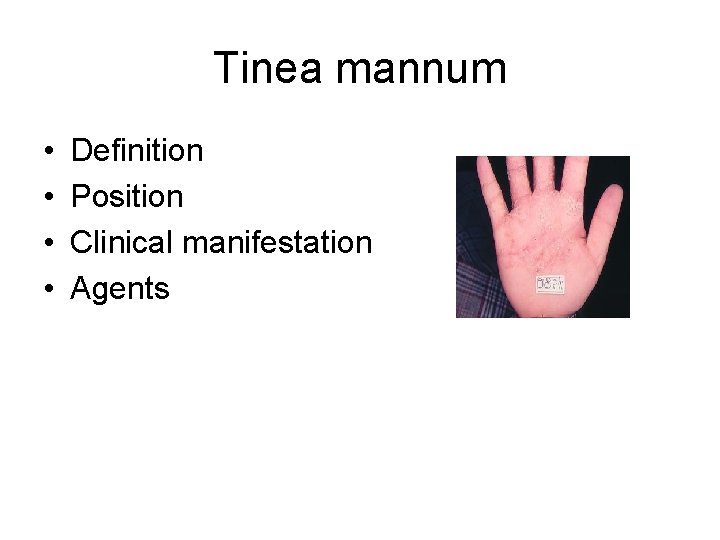 Tinea mannum • • Definition Position Clinical manifestation Agents 
