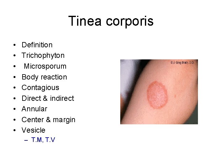 Tinea corporis • • • Definition Trichophyton Microsporum Body reaction Contagious Direct & indirect