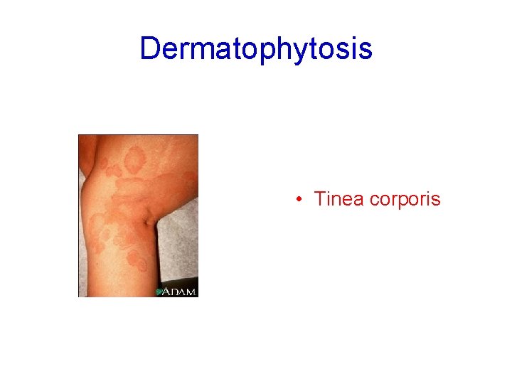 Dermatophytosis • Tinea corporis 