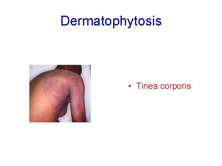 Dermatophytosis • Tinea corporis 