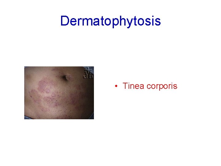 Dermatophytosis • Tinea corporis 