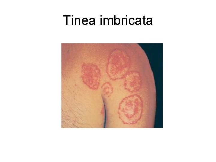 Tinea imbricata 