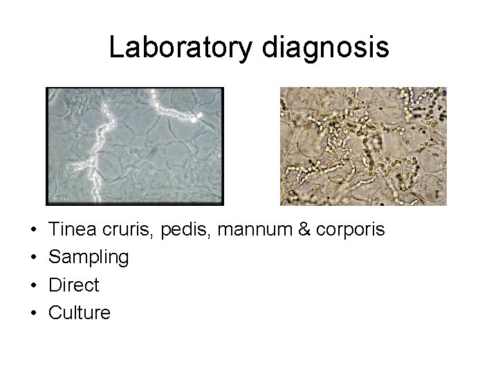 Laboratory diagnosis • • Tinea cruris, pedis, mannum & corporis Sampling Direct Culture 