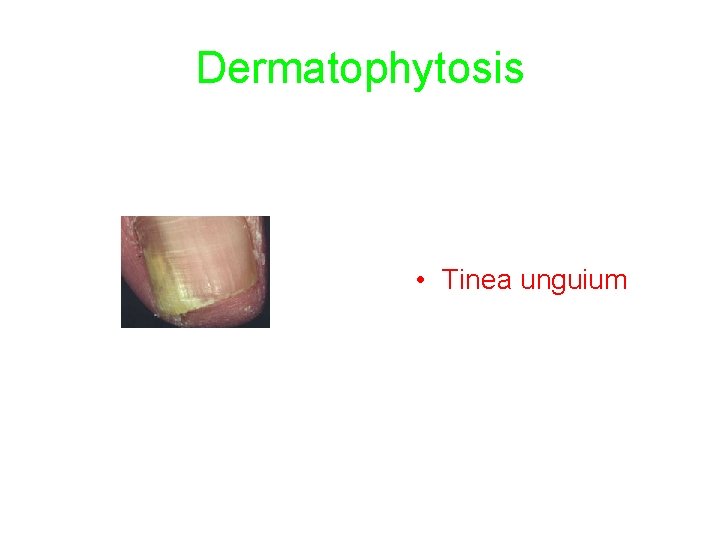 Dermatophytosis • Tinea unguium 