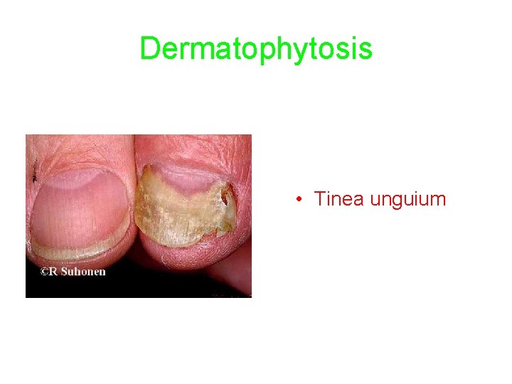 Dermatophytosis • Tinea unguium 