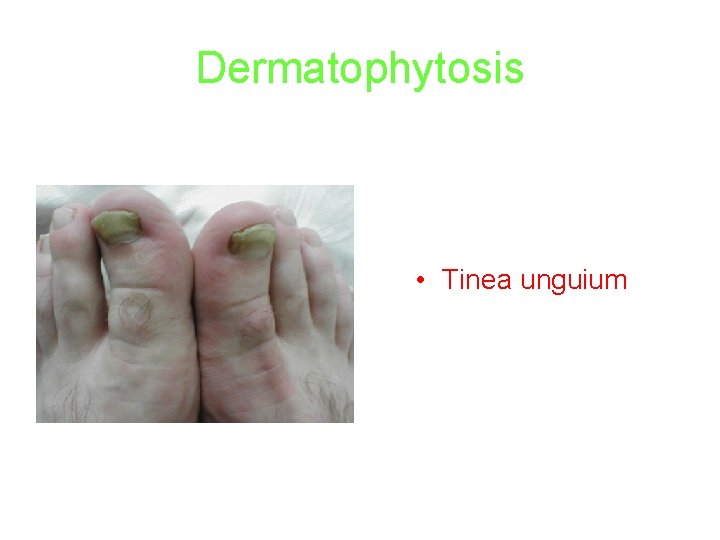 Dermatophytosis • Tinea unguium 