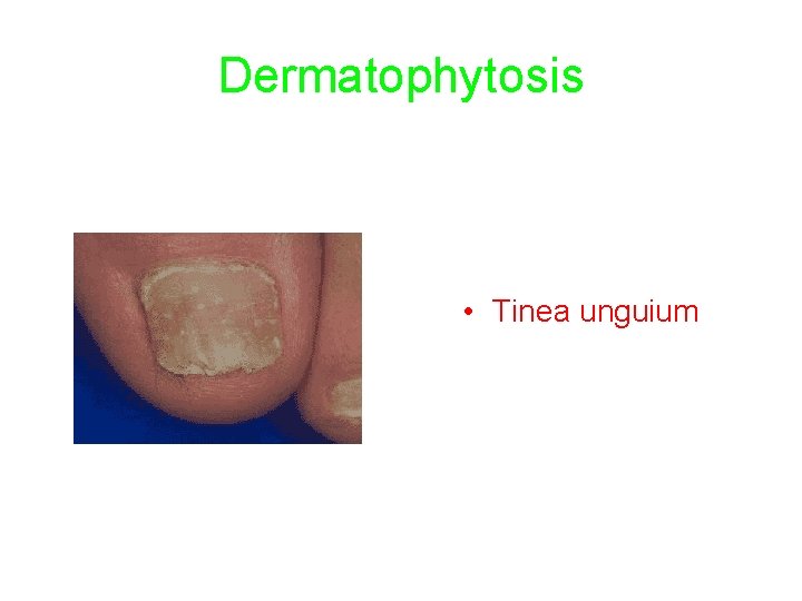 Dermatophytosis • Tinea unguium 