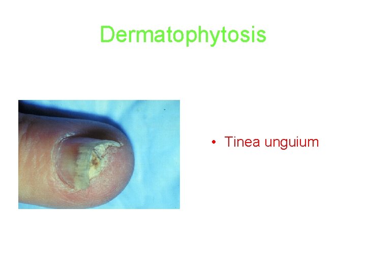 Dermatophytosis • Tinea unguium 