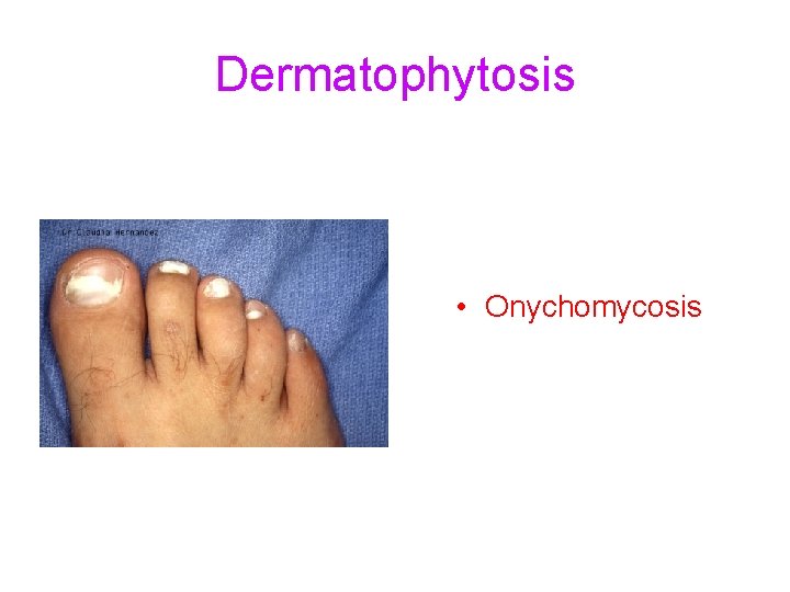Dermatophytosis • Onychomycosis 