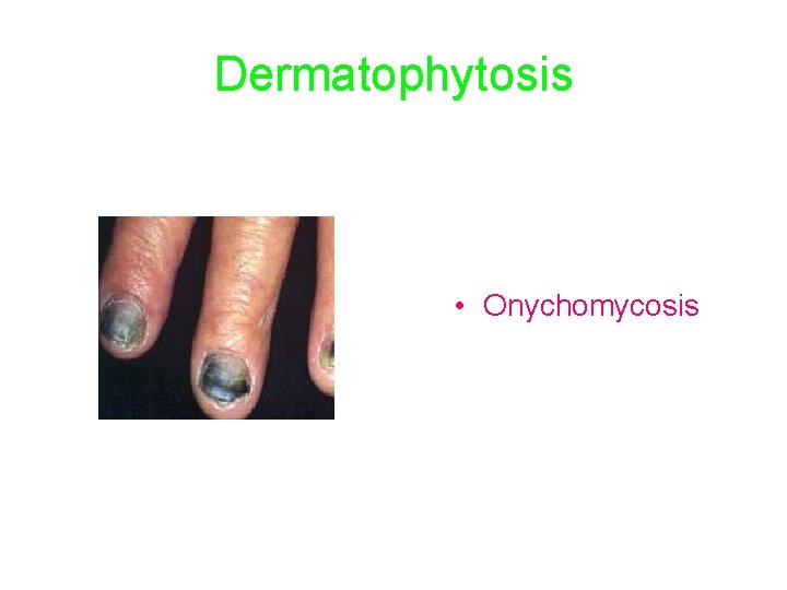 Dermatophytosis • Onychomycosis 