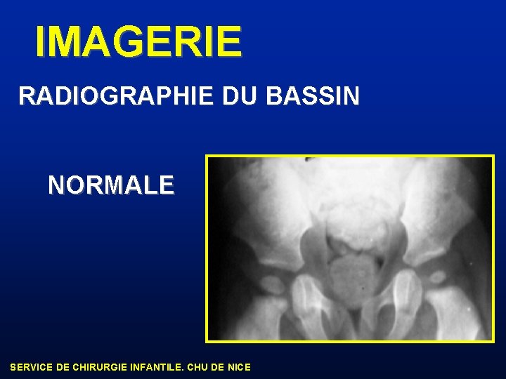 LES BOITERIES J GRIFFET SERVICE DE CHIRURGIE INFANTILE