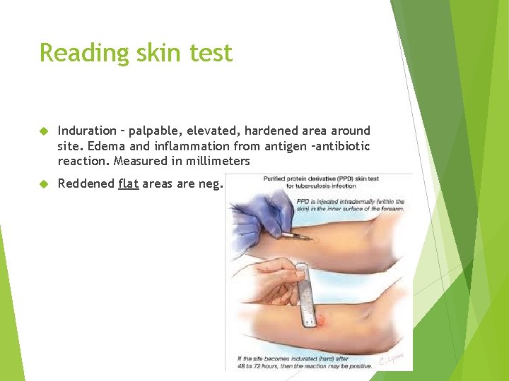 Reading skin test Induration – palpable, elevated, hardened area around site. Edema and inflammation