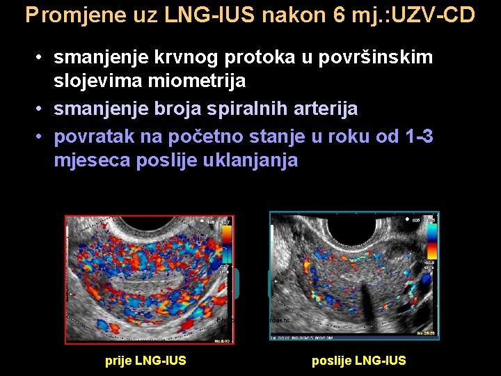 Promjene uz LNG-IUS nakon 6 mj. : UZV-CD • smanjenje krvnog protoka u površinskim